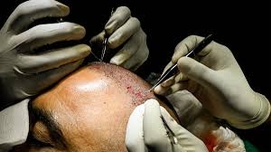 زراعة شعر تنتهي بمأساة: وفاة رجلين في الهند بعد عمليات فاشلة تثير غضبًا واسعًا
